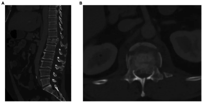Travmatik spinal kanal retropulsiyonu: yayımlanmış olgu görüntüsü, sagittal ve aksiyel kesit