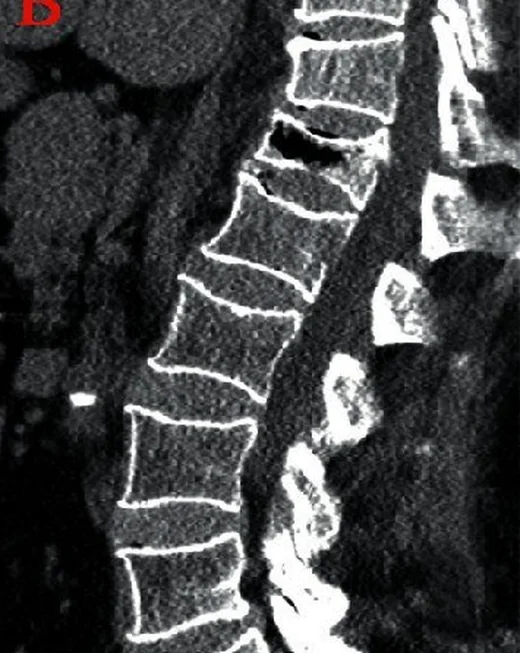 İntravertebral vakum yarığı (Kümmell ile ilişkili görünüm): yayımlanmış olgu görüntüsü, sagittal kesit