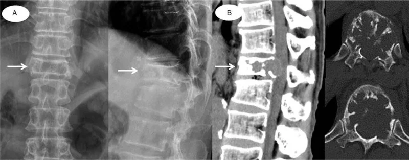 Malignite ilişkili patolojik kompresyon kırığı: yayımlanmış olgu görüntüsü, sagittal kesit