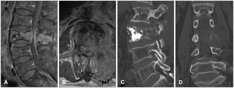 Kompresyon kırığında pedikül ve arka eleman tutulumu: yayımlanmış olgu görüntüsü, sagittal ve koronal kesit