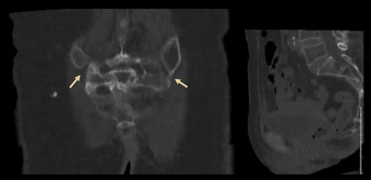 AO Spine sakral kırık sınıflaması: yayımlanmış olgu görüntüsü, koronal+sagittal kesit