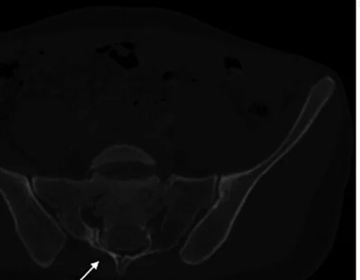 Transvers sakral kırık: yayımlanmış olgu görüntüsü, sagittal kesit