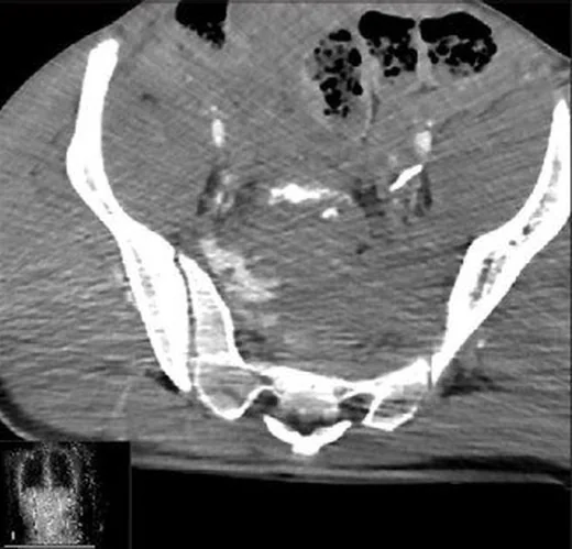 Sakral U/H tipi kırık ve spinopelvik ayrışma: yayımlanmış olgu görüntüsü, sagittal kesit