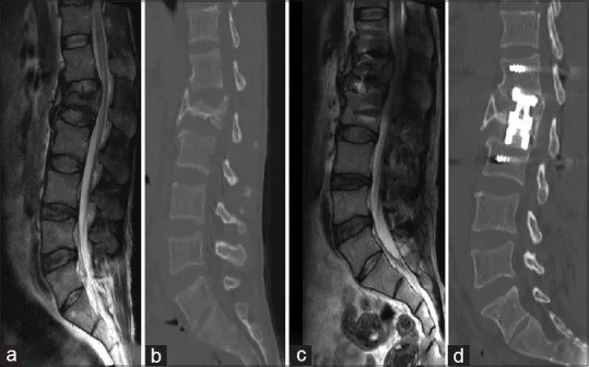 TLICS bileşenleri: yayımlanmış olgu görüntüsü, sagittal kesit