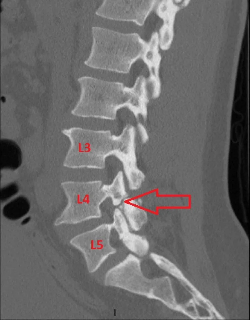 Travmatik pars interartikülaris kırığı: yayımlanmış olgu görüntüsü, sagittal kesit