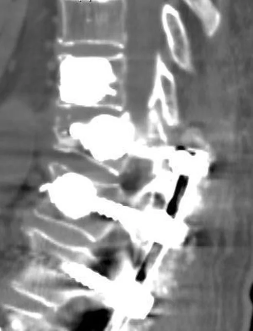 Torakolomber subluksasyon: yayımlanmış olgu görüntüsü, sagittal kesit