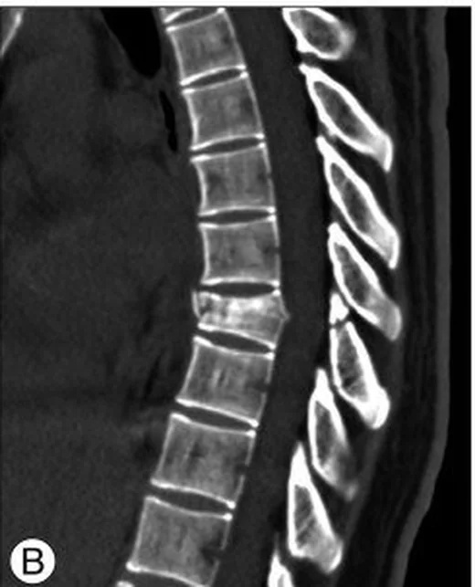 TLICS (Torakolomber Yaralanma Sınıflama ve Şiddet Skoru): yayımlanmış olgu görüntüsü, sagittal kesit
