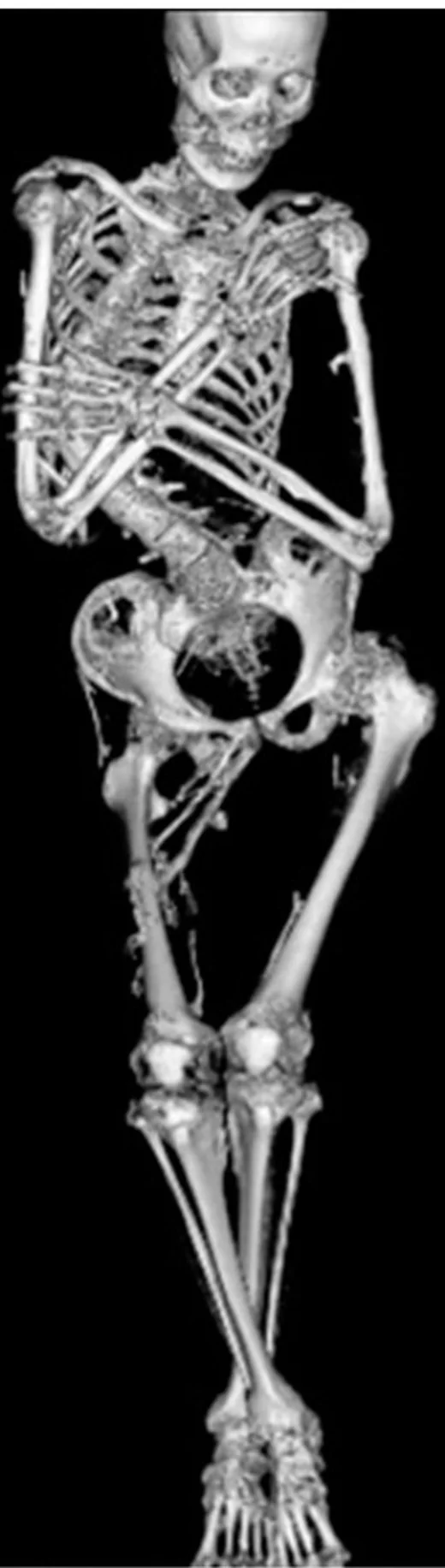Fibrodysplasia ossificans progressiva: yayımlanmış olgu görüntüsü, 3B kesit