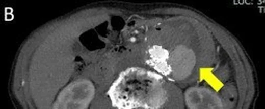 Abdominal aort anevrizması: yayımlanmış olgu görüntüsü, aksiyel kesit