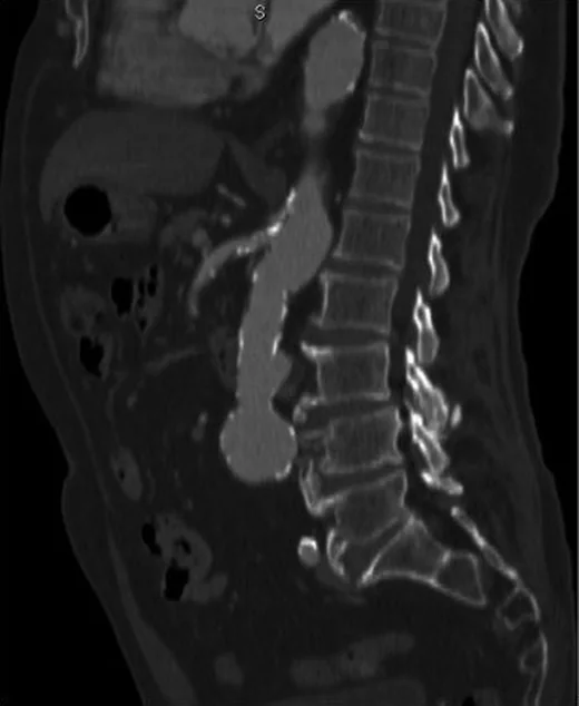Abdominal aort psödoanevrizması: yayımlanmış olgu görüntüsü, koronal kesit