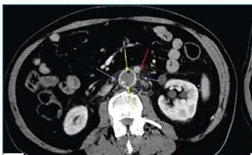 Abdominal aortit: yayımlanmış olgu görüntüsü, aksiyel kesit