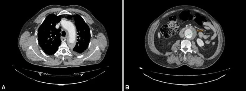 Abdominal aort intramural hematomu: yayımlanmış olgu görüntüsü, aksiyel kesit