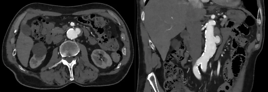 Abdominal penetran aterosklerotik ülser: yayımlanmış olgu görüntüsü, aksiyel kesit