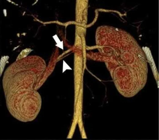 Aksesuar veya erken dallanan renal arter: yayımlanmış olgu görüntüsü, aksiyel kesit