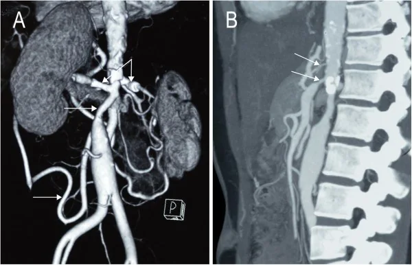 Abdominal aort ve visseral ostium aterosklerozu: yayımlanmış olgu görüntüsü, 3B kesit