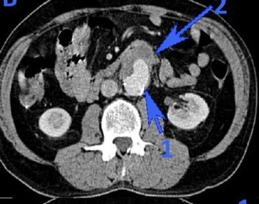 Aortoenterik fistül: yayımlanmış olgu görüntüsü, aksiyel kesit