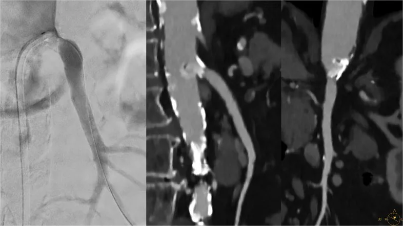 Kalsifiye ostial plak ve blooming taklitçisi: yayımlanmış olgu görüntüsü, sagittal kesit