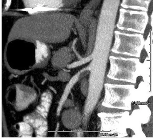 Kronik mezenterik iskemik damar hastalığı: yayımlanmış olgu görüntüsü, sagittal kesit