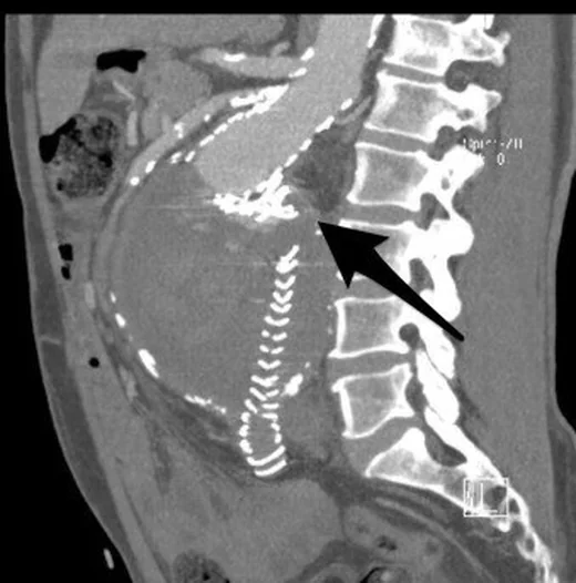 Tip III endoleak: yayımlanmış olgu görüntüsü, sagittal kesit