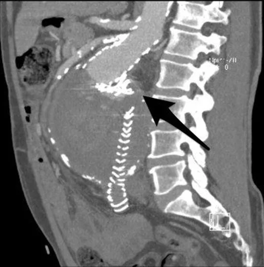 EVAR greft mekanik komplikasyonları: yayımlanmış olgu görüntüsü, sagittal kesit