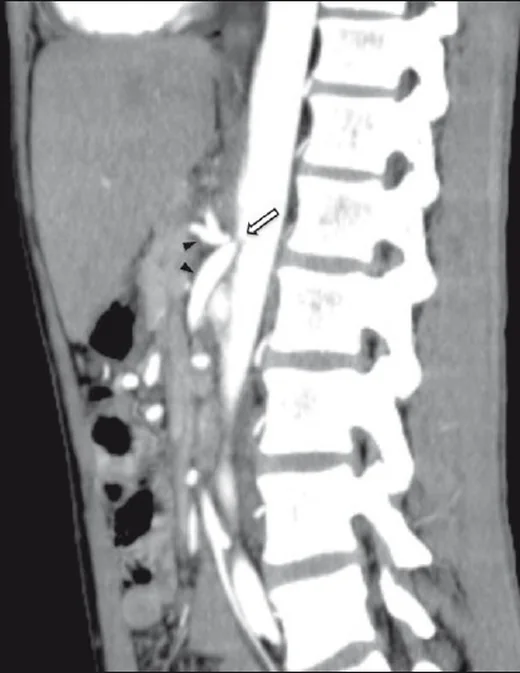 Median arkuat ligament ilişkili çölyak arter basısı: yayımlanmış olgu görüntüsü, sagittal kesit