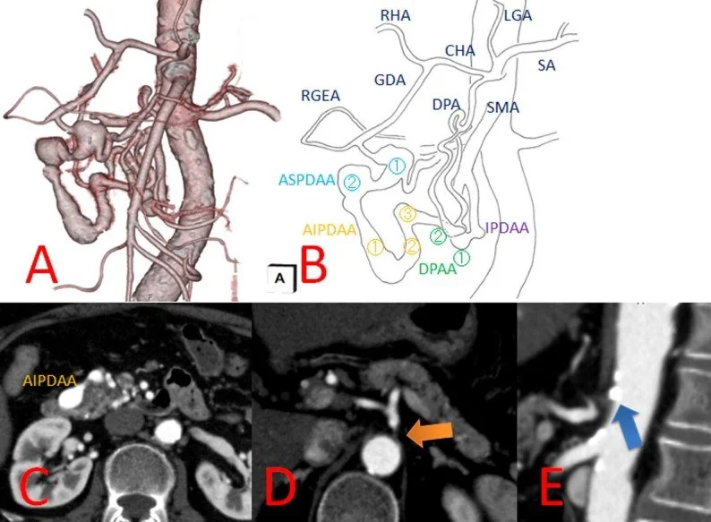 Pankreatikoduodenal veya gastroduodenal arter anevrizması: yayımlanmış olgu görüntüsü, aksiyel kesit