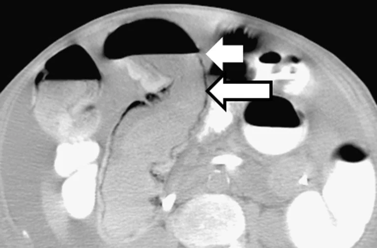 Benign pneumatosis ve mezenterik venöz gaz taklitleri: yayımlanmış olgu görüntüsü, aksiyel kesit
