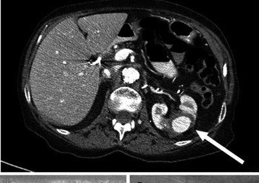 Renal arter anevrizması veya psödoanevrizması: yayımlanmış olgu görüntüsü, aksiyel kesit