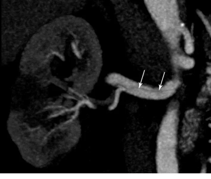 Renal arter diseksiyonu ve renal infarkt: yayımlanmış olgu görüntüsü, 3B kesit