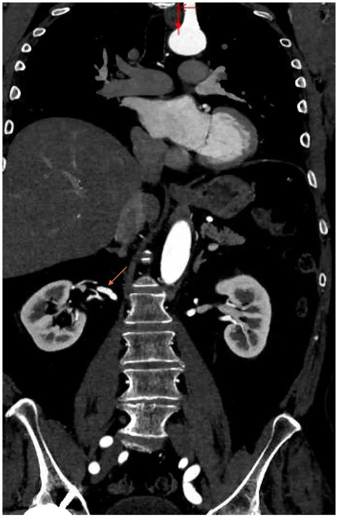 Renal arter fibromüsküler displazisi: yayımlanmış olgu görüntüsü, koronal kesit