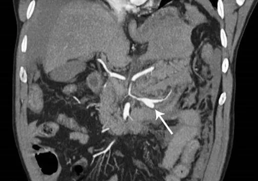 Segmental arteriyel mediolizis: yayımlanmış olgu görüntüsü, koronal kesit