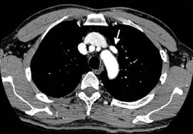 Anormal pulmoner venöz dönüş: yayımlanmış olgu görüntüsü, aksiyel kesit