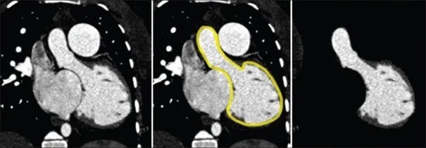 Atriyoventriküler septal defekt: yayımlanmış olgu görüntüsü, koronal kesit