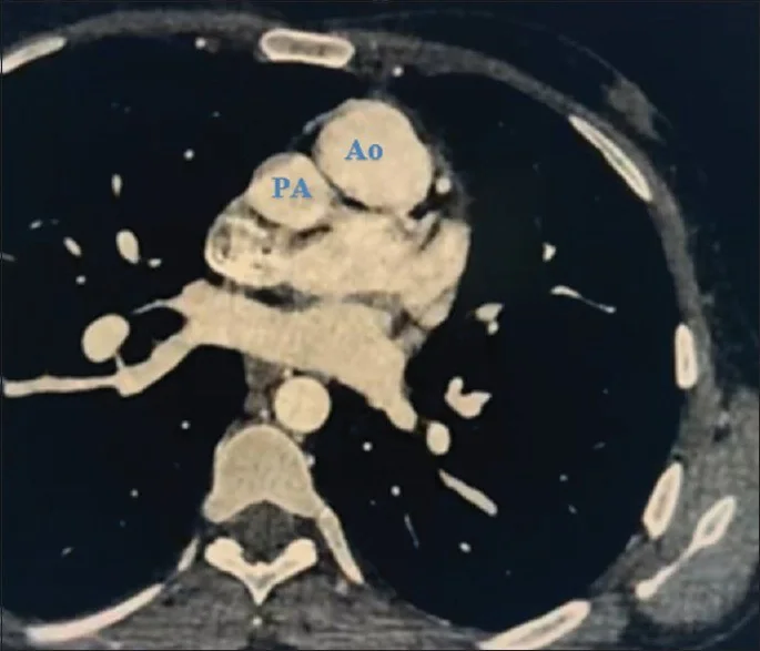 Büyük arterlerin transpozisyonu: yayımlanmış olgu görüntüsü, aksiyel kesit