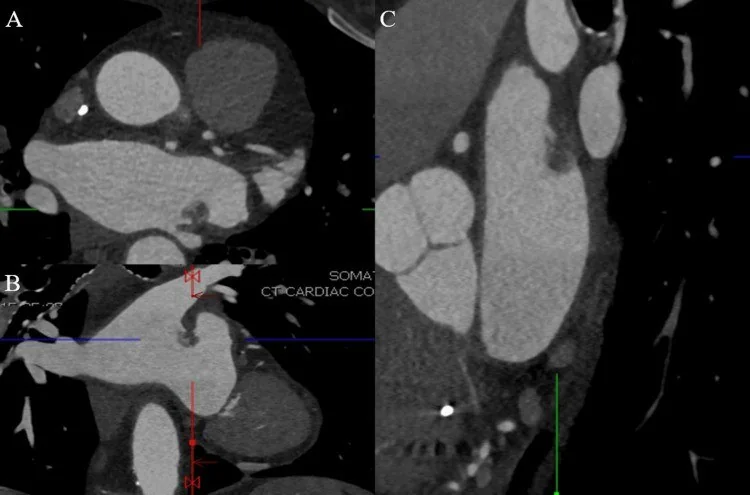 Coumadin çıkıntısı (sol üst pulmoner ven çıkıntısı): yayımlanmış olgu görüntüsü, aksiyel kesit