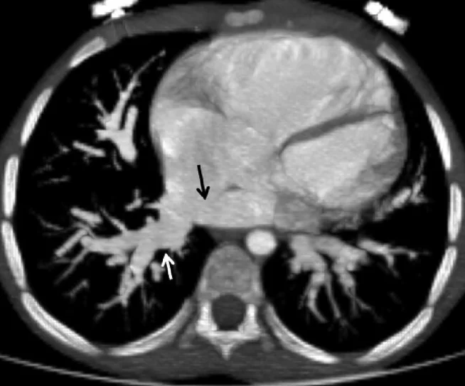 Parsiyel anormal pulmoner venöz dönüş: yayımlanmış olgu görüntüsü, aksiyel kesit