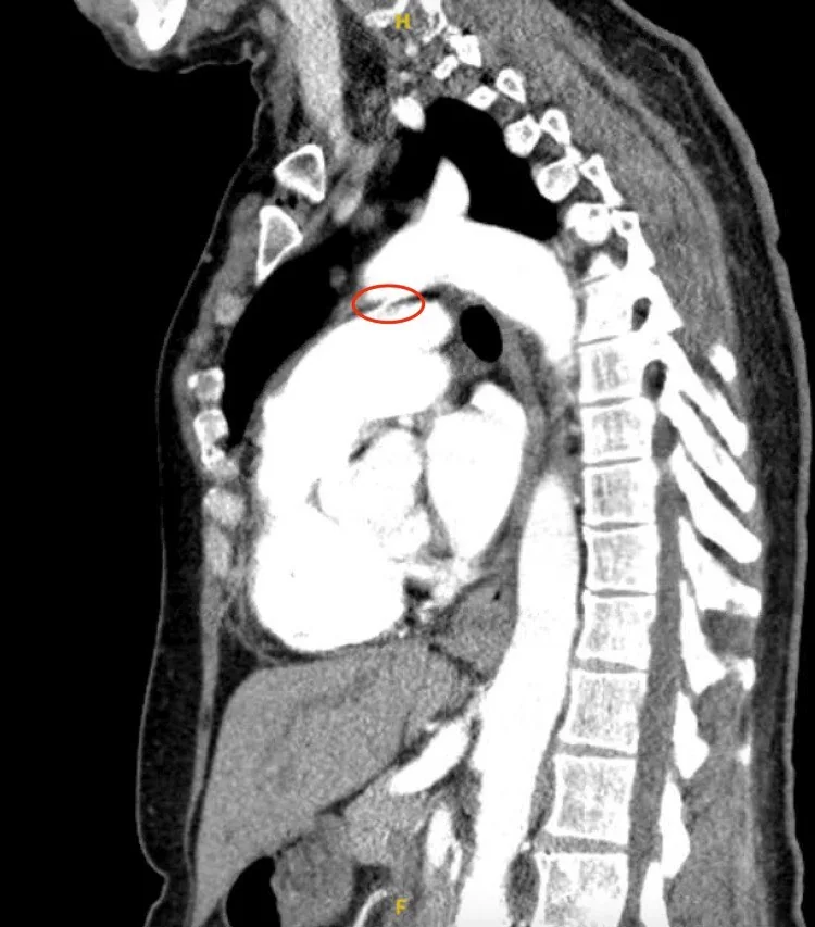 Patent duktus arteriozus: yayımlanmış olgu görüntüsü, sagittal kesit