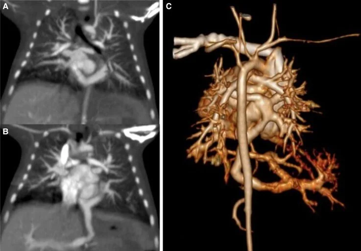 Total anormal pulmoner venöz dönüş: yayımlanmış olgu görüntüsü, koronal+3B kesit