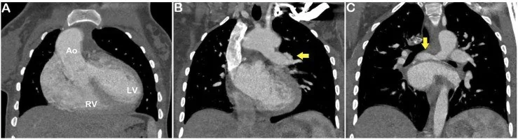 Ventriküler septal defekt: yayımlanmış olgu görüntüsü, koronal kesit