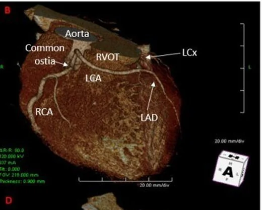 Anomalik koronerin retroaortik, prepulmonik veya intraseptal seyri: yayımlanmış olgu görüntüsü, 3B kesit