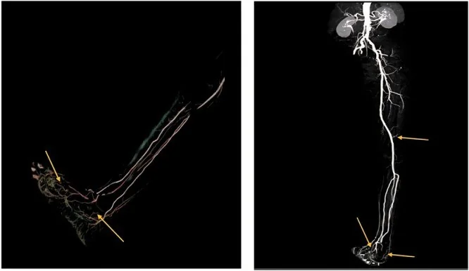 Tromboanjitis obliterans (Buerger hastalığı): yayımlanmış olgu görüntüsü, 3B kesit