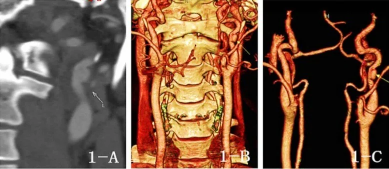 Ekstrakraniyal karotis arter anevrizması: yayımlanmış olgu görüntüsü, sagittal kesit