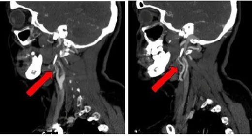 Karotis diseksiyonu: yayımlanmış olgu görüntüsü, sagittal kesit