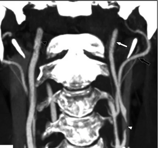 Karotis near-occlusion ve distal kollaps: yayımlanmış olgu görüntüsü, sagittal ve koronal kesit