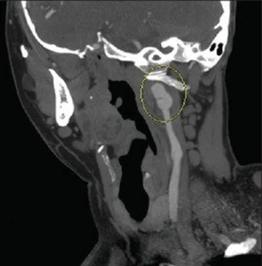 Karotis psödoanevrizması: yayımlanmış olgu görüntüsü, sagittal kesit