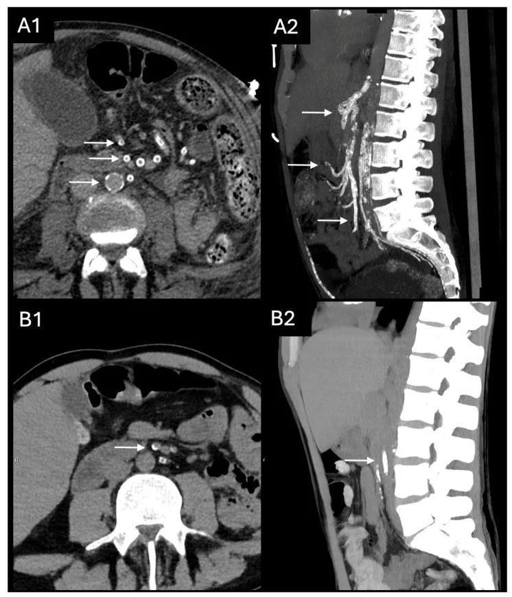Medial arteriyel kalsinoz (Mönckeberg tipi): yayımlanmış olgu görüntüsü, aksiyel kesit