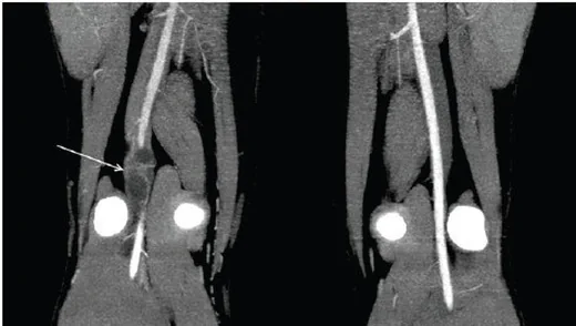 Popliteal arter adventisyal kistik hastalığı: yayımlanmış olgu görüntüsü, aksiyel kesit