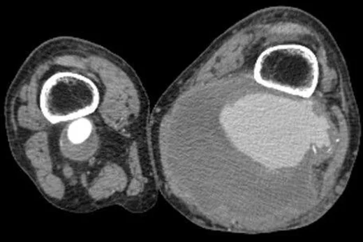 Popliteal arter anevrizması: yayımlanmış olgu görüntüsü, aksiyel kesit