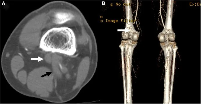 Popliteal arter tuzaklanma sendromu: yayımlanmış olgu görüntüsü, aksiyel kesit