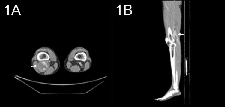 Popliteal anevrizma trombozu ve distal embolizasyon: yayımlanmış olgu görüntüsü, aksiyel+sagittal kesit